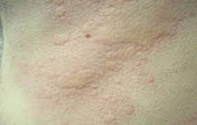 Home Remedies For Hives Home Remedies For Allergies Natural Remedies For Allergies Allergy Remedies