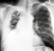 We did not find results for: Pleura Chest Wall And Diaphragm Radiology Key