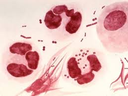Image result for gonorrhea symptoms