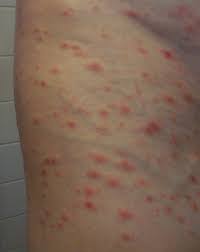Sie leiden an fieber, abgeschlagenheit und einer mandelentzündung. Pityriasis Lichenoides Et Varioliformis Acuta Wikipedia