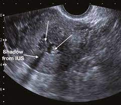 If a mass was found on bimanual palpation, the yield of abnormal ultrasound was much higher (52%). Ultrasound Imaging Of Women With Abnormal Uterine Bleeding Aub Chapter 13 Ultrasound In Reproductive Healthcare Practice