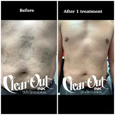 Combine 1 tablespoon of aloe vera gel, 2 capsules of vitamin e, and 1 tablespoon of the gel created by paederia tomentosa leaves. Best Las Vegas Tattoo Removal Clear Out Ink Laser Tattoo Removal