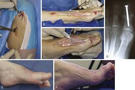 We did not find results for: Disorders Of Tendons Musculoskeletal Key