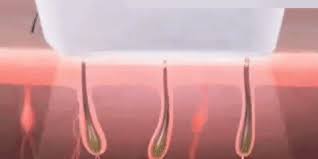 During laser hair removal, a laser emits a light that is absorbed by the pigment (melanin) in the hair. Ipl Laser Hair Removal Handset Geniwo In 2021 Ipl Hair Removal Ipl Laser Hair Removal Laser Hair Removal