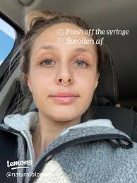 Essential Guide to Getting Lip Fillers