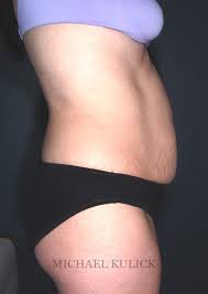 Most la jolla moms who consult with me about a tummy tuck procedure are looking for lasting results. Choosing A Tummy Tuck After Pregnancy Reversing The Physical Impact Dr Kulick