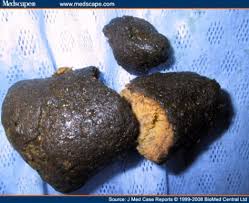 Image result for Bezoar