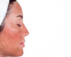 Avoid putting ice or extremely cold water on the burn. What S Your Recipe For Treating A Chemical Burn