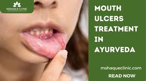 Image result for mouth ulcer on tongue)