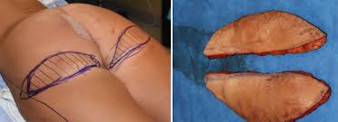 If your thread lift was performed to lift the buttocks, you will need to wait much longer than if your thread lift treated your marionette lines. Plastic Surgery Case Study A Lower Buttock Lift For Sagging Buttocks Infragluteal Ptosis Explore Plastic Surgery