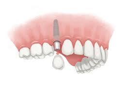 Maybe you would like to learn more about one of these? How Much Does A Tooth Implant Cost Without Insurance Dental News Network