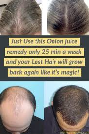 Just Use This Onion Juice Remedy For 25 Min A Week And Your Lost Hair Will Grow Back Again Like It S Magic Lost Hair Help Hair Loss Onion Hair Growth