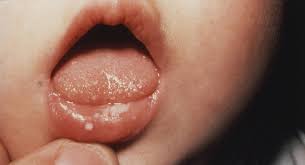 In few cases, oral leukoplakia may be cancerous. Thrush In Babies Babycentre Uk