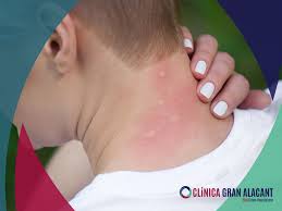 Image result for spinne biss haut reaktion