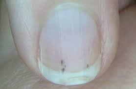 We did not find results for: What Should I Do If I Have A Dark Spot Under My Fingernail Quora