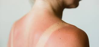 Image result for Sunburn