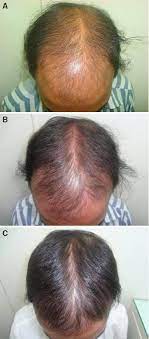 Additionally, zinc can help combat dandruff on the scalp as well. Controlled Clinical Trial For Evaluation Of Hair Growth With Low Dose Cyclical Nutrition Therapy In Men And Women Without The Use Of Finasteride