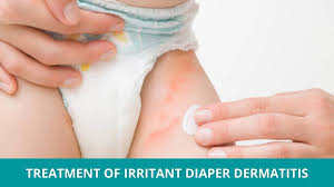 Image result for diaper dermatitis