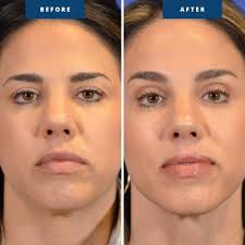 This patient underwent a surgical brow lift to elevate their brows, smooth  out forehead wrinkles, and reduce frown lines. The result? A refreshed,  youthful appearance that brightens their entire face! Swipe to