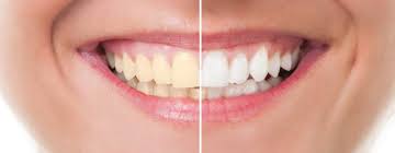 Efek Samping Memutihkan Gigi Putih Dengan Bleaching Hello Sehat