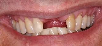 Protese Adesiva Em Resina Composta Reforcada Por Fibra De Vidro Surya Dental
