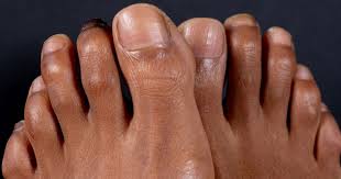 The skin on the surface may break down and look scraped. Hammer Toe Prevention And Treatment Familydoctor Org