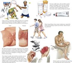 What Are The Symptoms Of Tinea Cruris Quora Jock itch is the common fungal infection that occurs in the groin area. what are the symptoms of tinea cruris