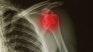 Image result for Shoulder XRay
