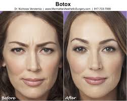 Botulinum toxin, or botox, as we call it, is a drug, precisely a neurotoxin derived from a bacterium called clostridium botulinum. How Long Botox To Work Rectangle Circle