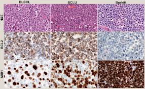 Niche suggesting a common cell of origin with disease evolution overlapping with related anterior mediastinal lymphomas. Grey Zones In The Differential Diagnosis Of Lymphoma Pathology Sciencedirect