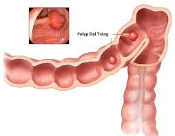 Tuy nhiên, nếu bệnh nhân gặp bất kỳ vấn đề gì, điều quan trọng là phải gặp bác sĩ ngay để tìm nguyên nhân và tiến hành điều trị, nếu cần thiết. Polyp Ä'áº¡i Trang Co Thá»ƒ Gay Ung ThÆ° Khong Kiáº¿n Thá»©c Cáº§n Náº¯m
