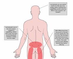 Lower back strain, also referred to as a pulled muscle, is caused by damage to the muscles and ligaments of the lower back. Cureus Low Back Pain Among Weightlifting Adolescents And Young Adults