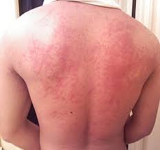 Food Allergy Wikipedia