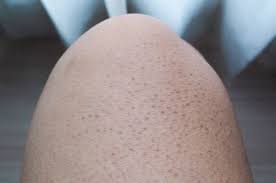 Bagaimana tidak kumbang jinak terbang beredar, jika tidak kerana bunga kembang di taman. Tak Perlu Pemeriksaan Khusus Begini Cara Deteksi Keratosis Pilaris