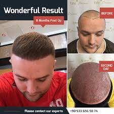Hair Transplant Result