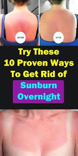 How To Get Rid Of Sunburn Overnight 10 Best Ways To Heal Its Redness Get Rid Of Sunburn Sunburn Relief Instant Sunburn Treatment