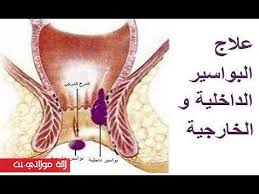 وصفة معجزة ادهشت الاطباء لعلاج البواسير الداخلية والخارجية نهائيا بدون عملية مجربة وفعالة 100