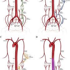 Systemic Collateral Pathways In Aortoiliac Occlusive Disease A The Download Scientific Diagram