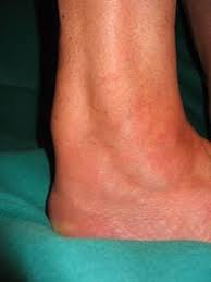 Ein achillessehnenriss (achillessehnenruptur) ist eine durchtrennung der achillessehne, die meistens durch eine überbeanspruchung der sehne bei einer sportlichen belastung entsteht. Achillessehne Univ Prof Dr Gabler Sportambulatorium