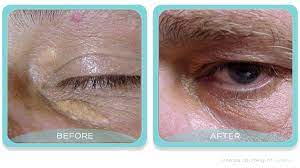 Your doctor will then surgically remove your eyelid xanthelasma and stitch it up. 17 Xanthelasma Ideas The Cure Reduce Cholesterol Cholesterol Lowering Foods
