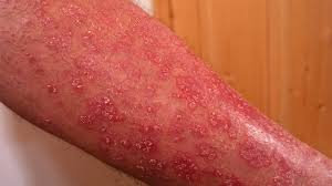 Psoriasis is a skin condition that causes red, flaky, crusty patches of skin covered with silvery scales. Psoriase Doenca Afeta Ate 5 Milhoes De Brasileiros Aponta Sbd