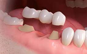 Check spelling or type a new query. Dental Bridge Affordable And Fixed Missing Teeth Replacement