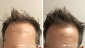 Microneedling works by making controlled microinjuries in your skin, which your body will then heal while producing collagen, whitney explains. Balding After A Hair Transplant National Hair Loss
