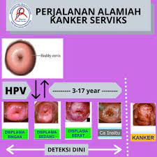 Stop kanker serviks;cegah sedini mungkin dan sayangilah kesehatan anda Perjalanan Alamiah Kanker Serviks Yayasan Rama Sesana