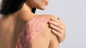 Kentang juga bisa sekaligus menghilangkan bekas jerawat di badan. Ganggu Banget Begini Cara Menghilangkan Jerawat Di Tubuh