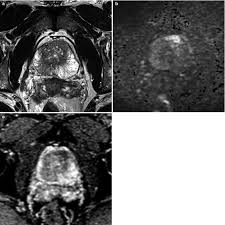 Whether you or someone you love has cancer, knowi. Fig 11 10 A C Pi Rads 4 Lesion In Diseases Of The Abdomen And Pelvis 2018 2021 Ncbi Bookshelf