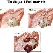 Different Stages Of Endometriosis In Pelvic Area Above