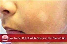White spots can appear on the skin when protein and dead cells become trapped under the surface, or when there is a loss of pigmentation. How To Get Rid Of White Spots On The Face Of Babies And Kids
