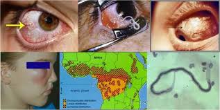 Loa Loa, or African Eyeworm
