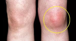 Image result for gout symptoms knee
